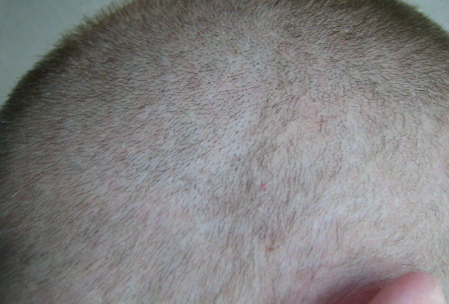 FUE hair transplant punch tool and graft preparation